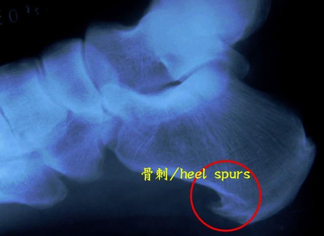 1511534812193151.jpg 跟痛症5.jpg