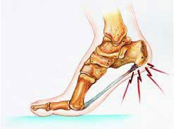 1511534749867565.jpg 跟痛症8.jpg