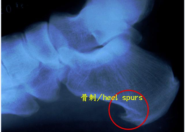 1514793802343138.png 跟痛症17.png