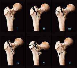 股骨转子间骨折临床治疗进展