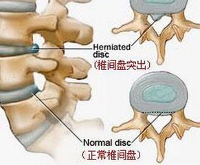椎间盘突出要如何保养