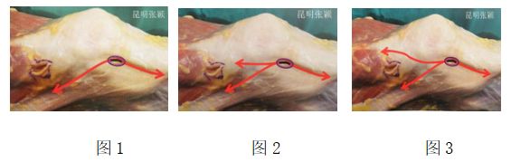 张颖：髌骨脱位手术治疗方案汇总