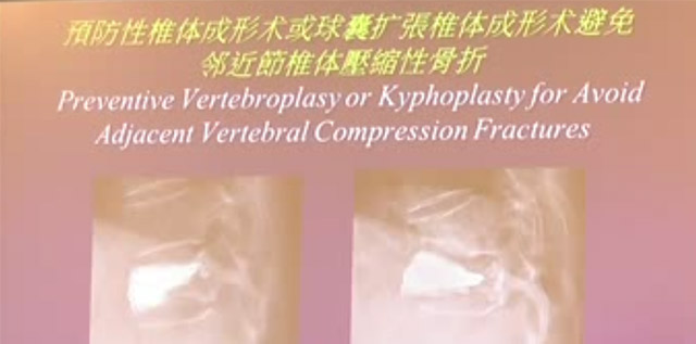 预防性椎体成形术或球囊扩张椎体成形术避免临近节椎体压缩性骨折