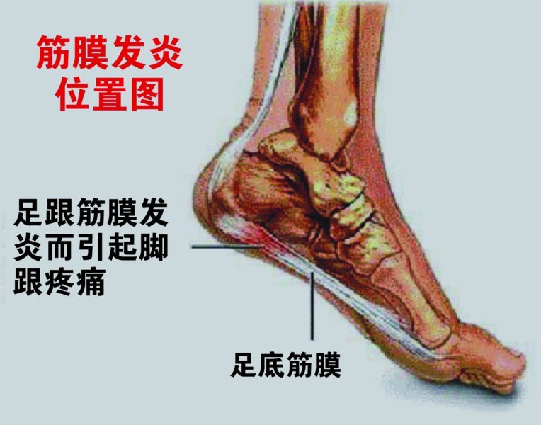 跟痛症4.jpg