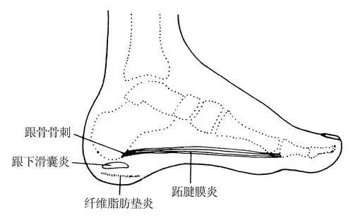 跟痛症3.jpg