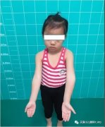 玖玖骨科小知识：TJPO科普---胳膊肘向里拐（肘内翻）