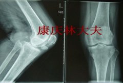 髌骨骨不连的治疗其实很简单--典型病例