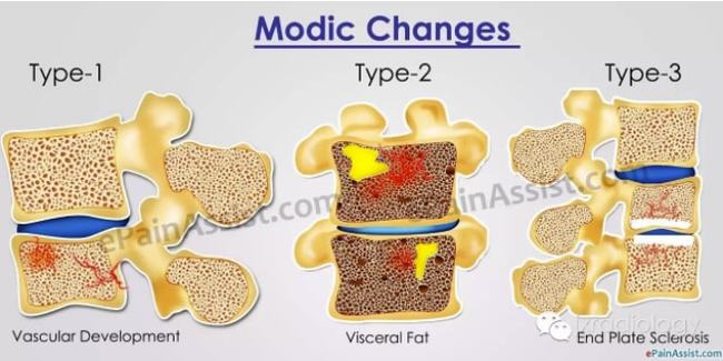 一文了解 | 终板炎 Modic 分型（Modic type）