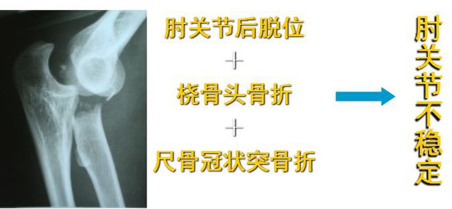 肘关节“恐怖三联征” 的规范化外科治疗